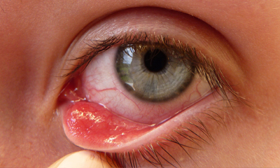 Заболевание глаз - ячмень