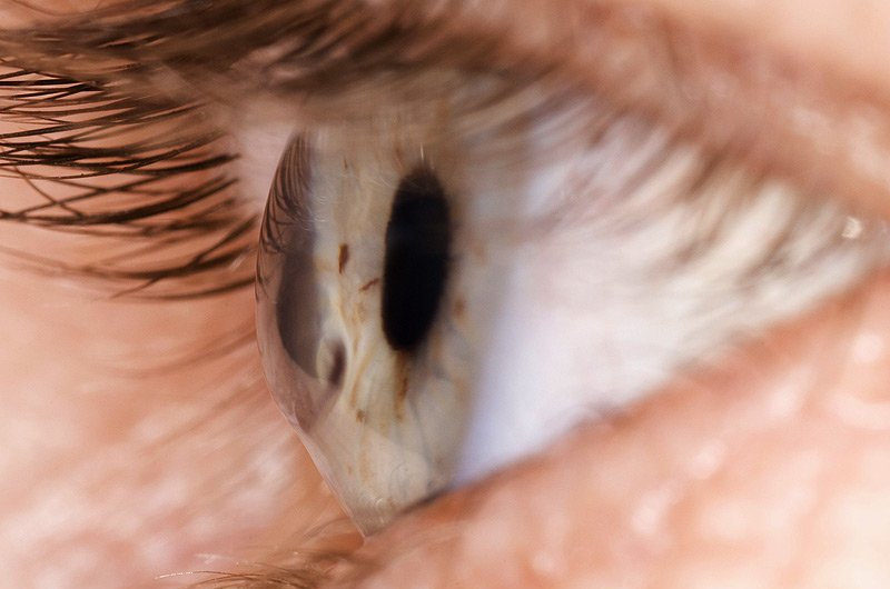 Кератоконус глаза