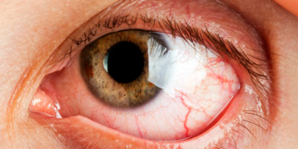 Вирусный кератит глаза