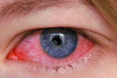 воспаление глаза - кератит