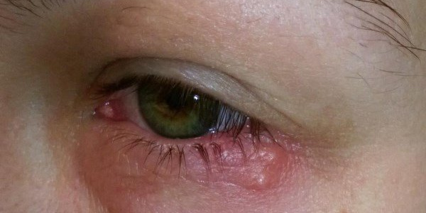 Офтальмогерпес глаза