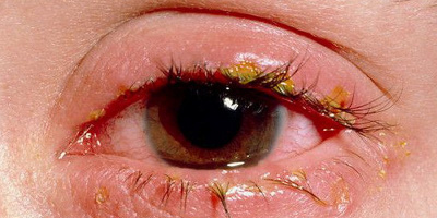Заболевания глаз - блефарит