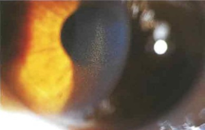 Пигментная открытоугольная глаукома