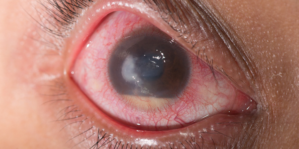 Первичная глаукома у взрослых