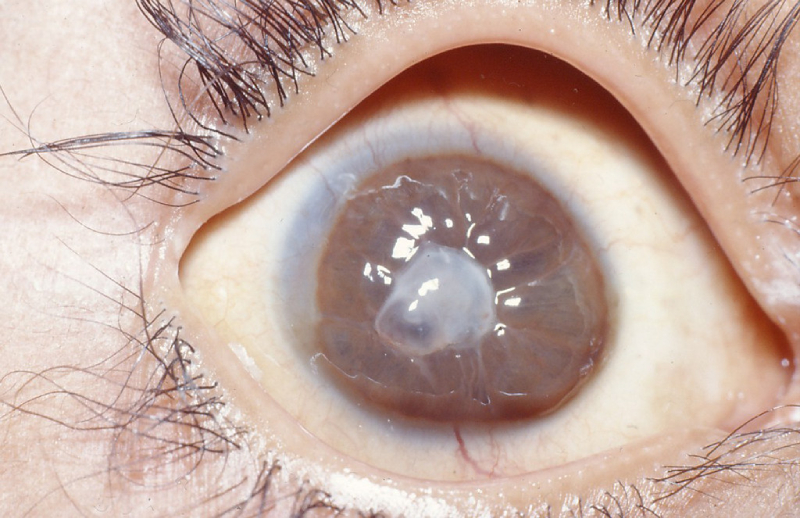 Кератомаляция глаза