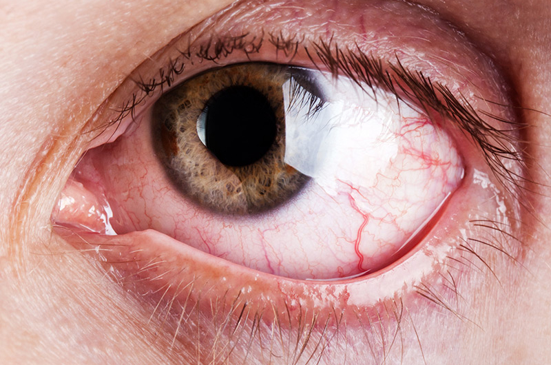 Ксерофтальмия глаза