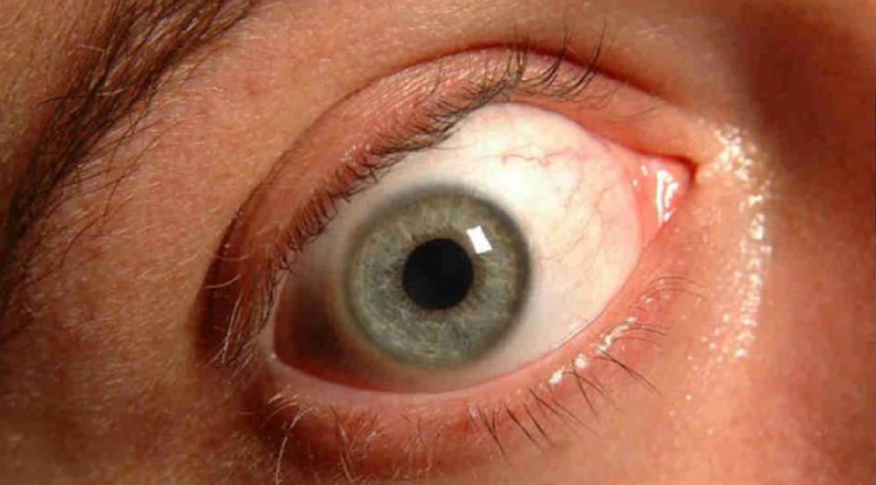 Первичная глаукома у взрослых