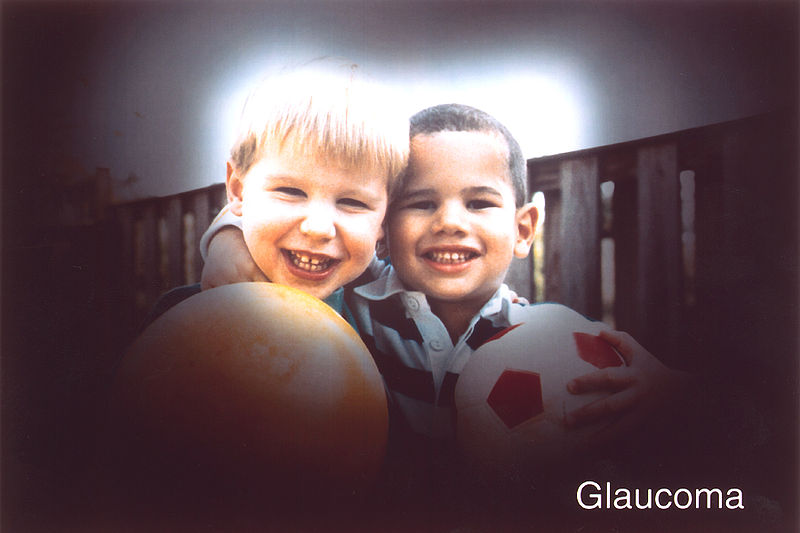 Глаукома у взрослых и детей